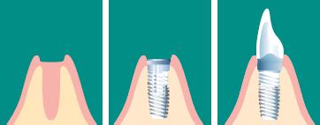 Dental Implants – Ashford Periodontics, Implantology & Endodontics.